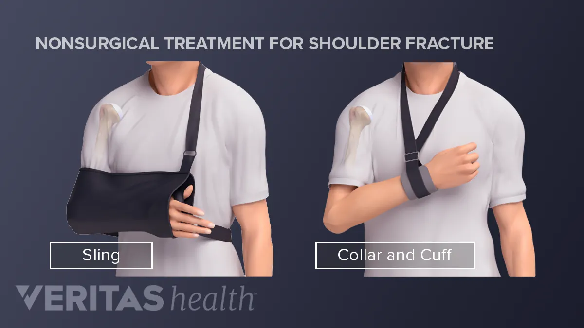 Arm Sling, Adults Upper Arm Arm Sling Immobilizer Fracture Broken