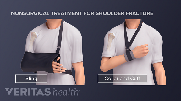 Person with a humerus fracture using a sling or collar and second inset showing using a  cuff.