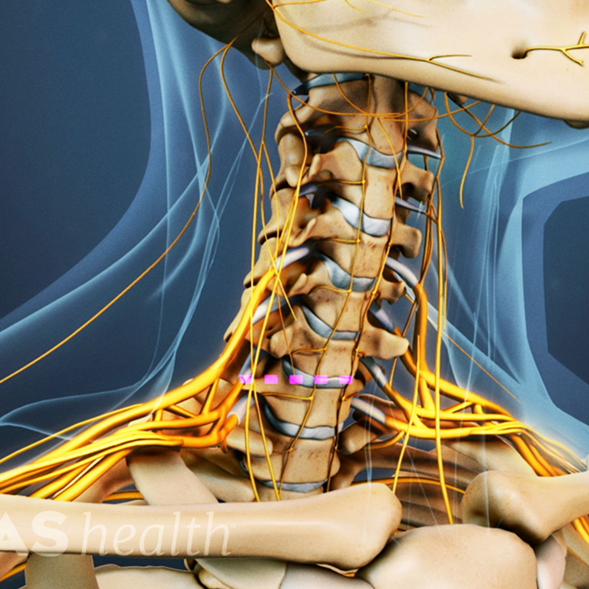 Full Range of Surgical Options for Spinal Stenosis