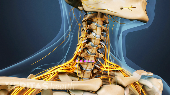 Treatment for Cervical Stenosis with Myelopathy