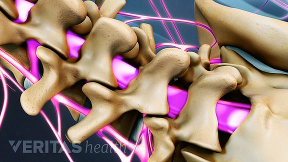 lumbar laminectomy