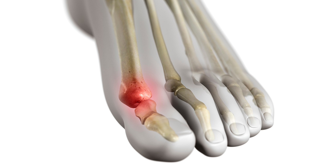 Turf Toe Symptoms