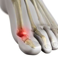 Skeletal view of the foot showing pain in the big toe.