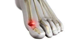 Gout