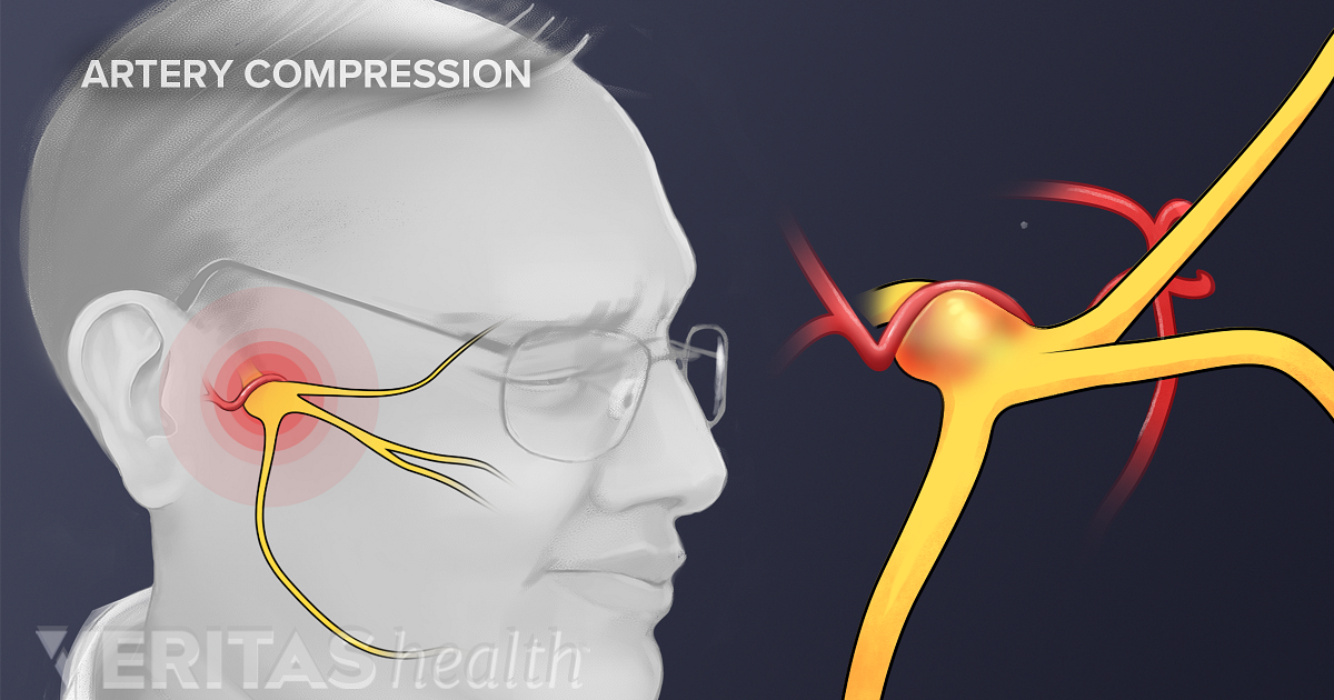 trigeminal-neuralgia-causes-and-risk-factors