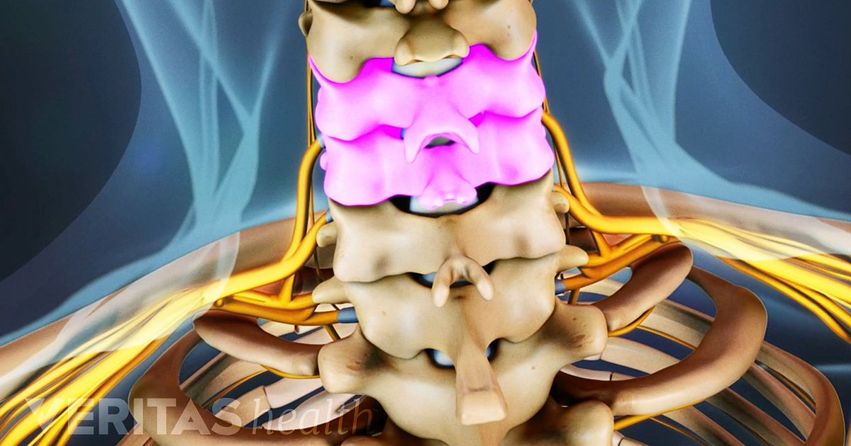 Anterior Cervical Discectomy and Fusion Complications