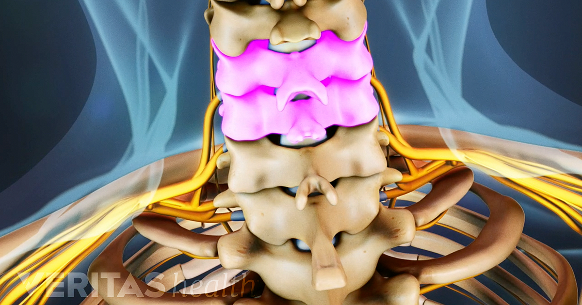 anterior-cervical-discectomy-and-fusion-complications