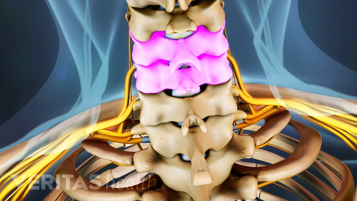 Anterior Cervical Discectomy and Fusion Complications | Spine-health