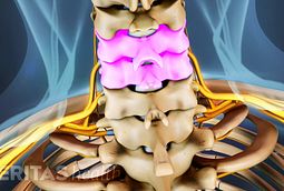 Anterior Cervical Decompression and Spine Fusion Procedure