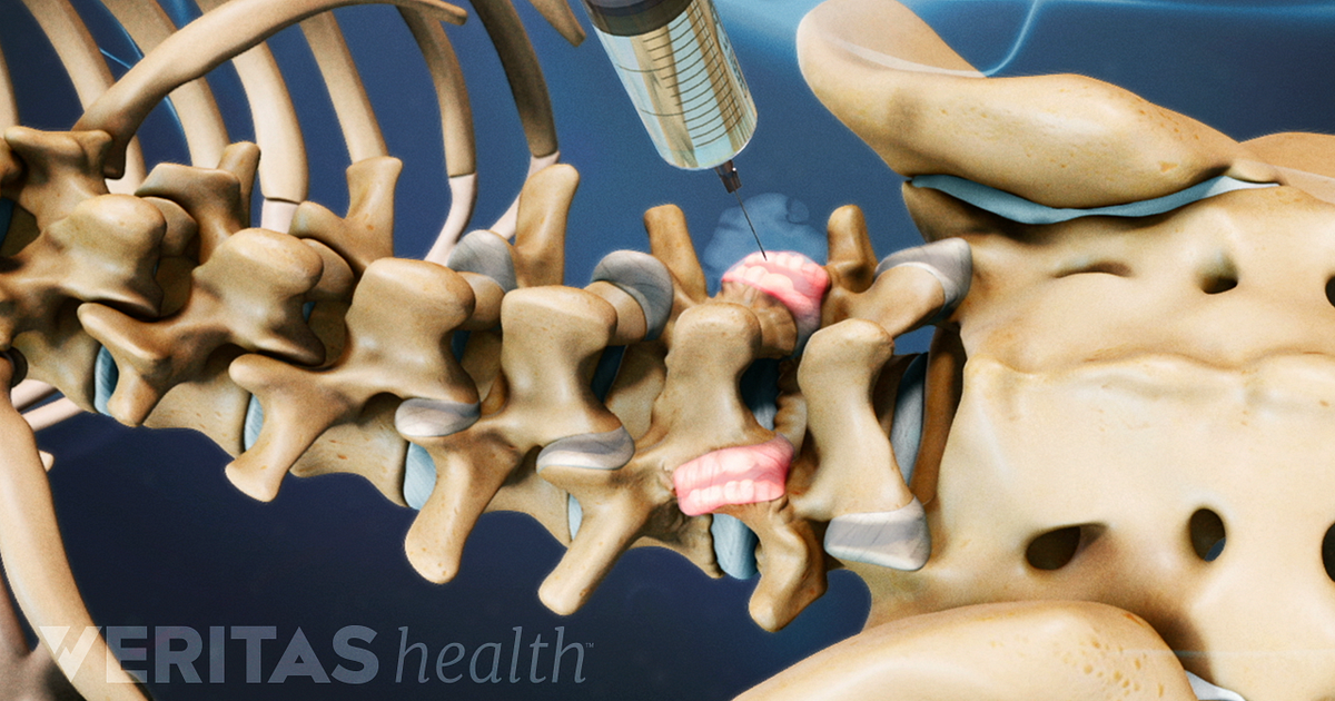 Lumbar Facet Joint Injection Procedure