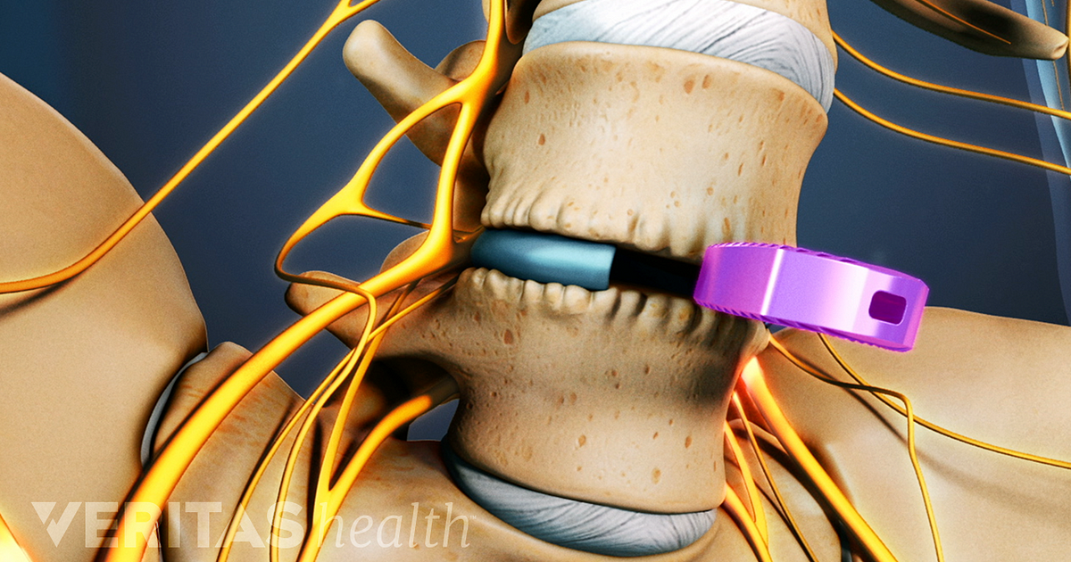 Surgical Treatments For Degenerative Disc Disease