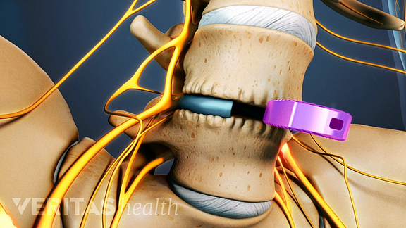 Rehabilitation Following Lumbar Fusion