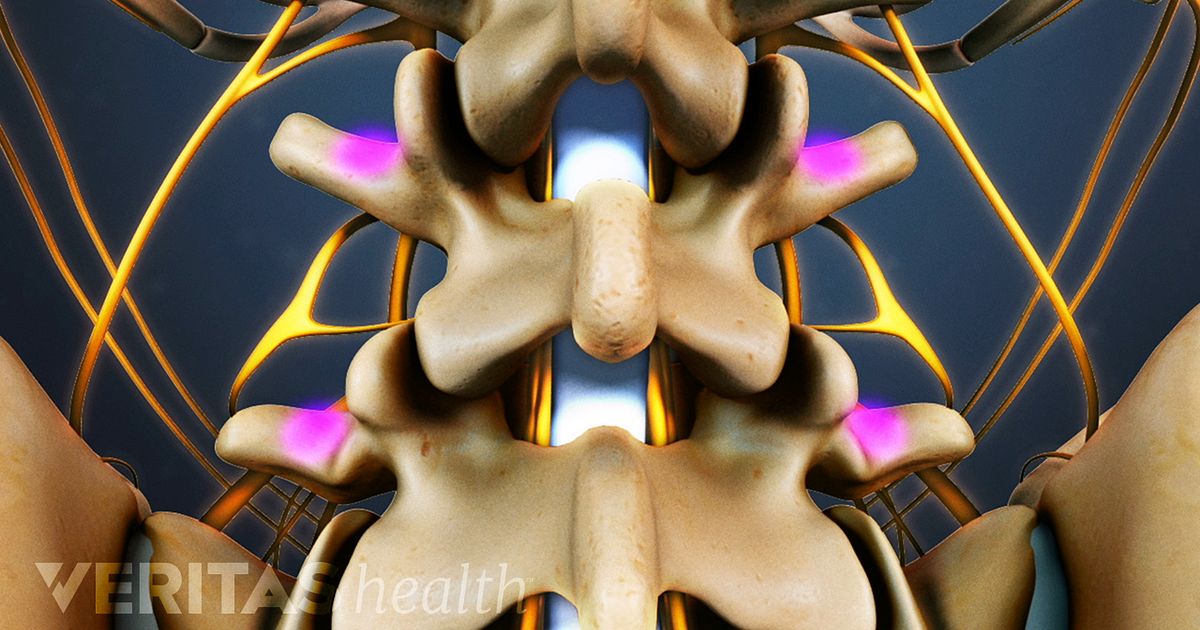 Posterolateral Gutter Spine Fusion Surgery