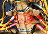 Anterior view of nerve root compression from cervical degenerative disc disease