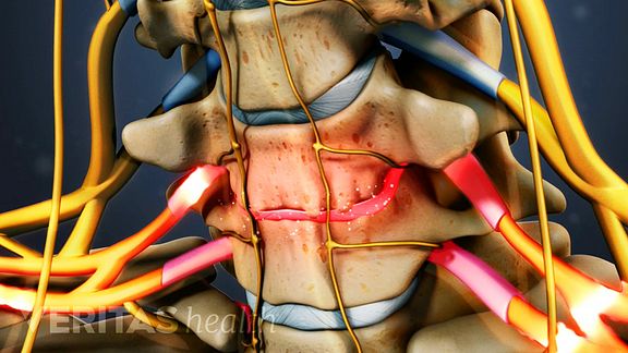 A Visual Guide to How Cervical Discs Degenerate