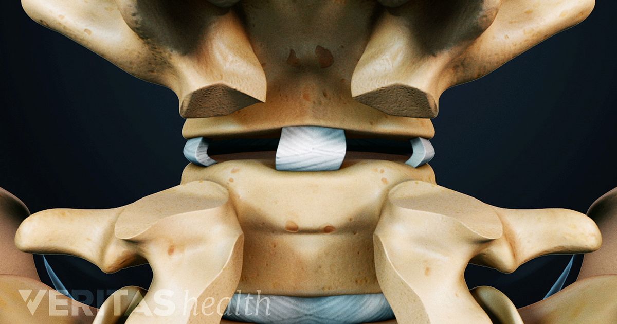 Posterior Lumbar Fusion