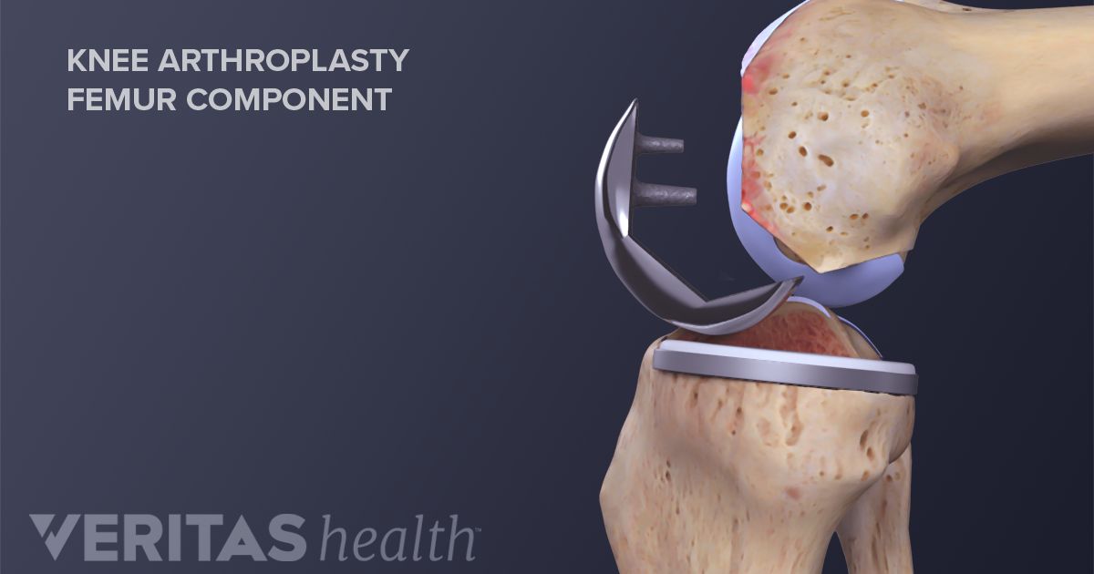 Traditional Knee Replacement Vs. Minimally Invasive Knee Replacement