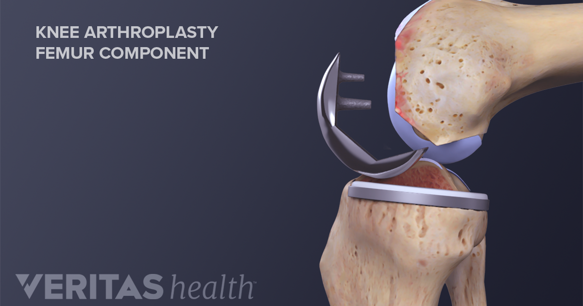 Knee Arthroplasty Definition | Defined By Arthritis-Health