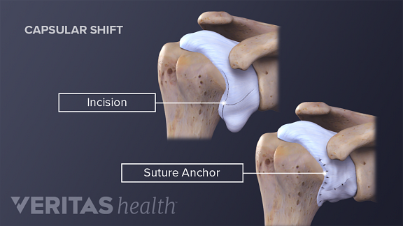 Anterior view of a capsular shift procedure