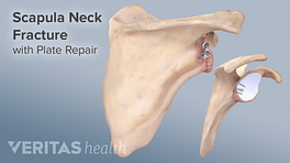Scapula neck fracture with a plate repair