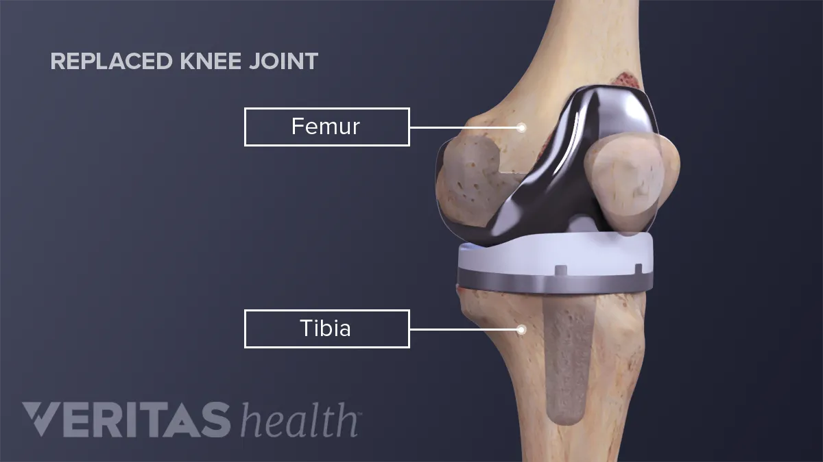 6 Exercises For Knee Replacement Recovery - Ortho Central