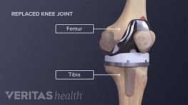 The Pros And Cons Of Minimally Invasive Knee Replacement Surgery