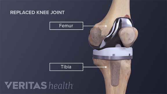 Medical illustration of a replaced knee joint labeling tibia and femur.