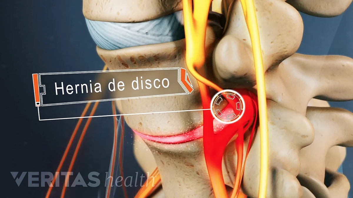 Qué es una hernia de un pinzamiento de un nervio, un disco protuberante? | Spine-health