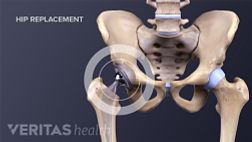Medical illustration showing a completed hip replacement