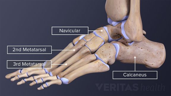 heel bone stress fracture