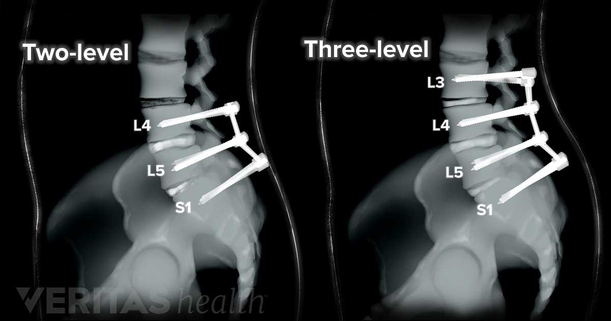 cervical spine levels x ray