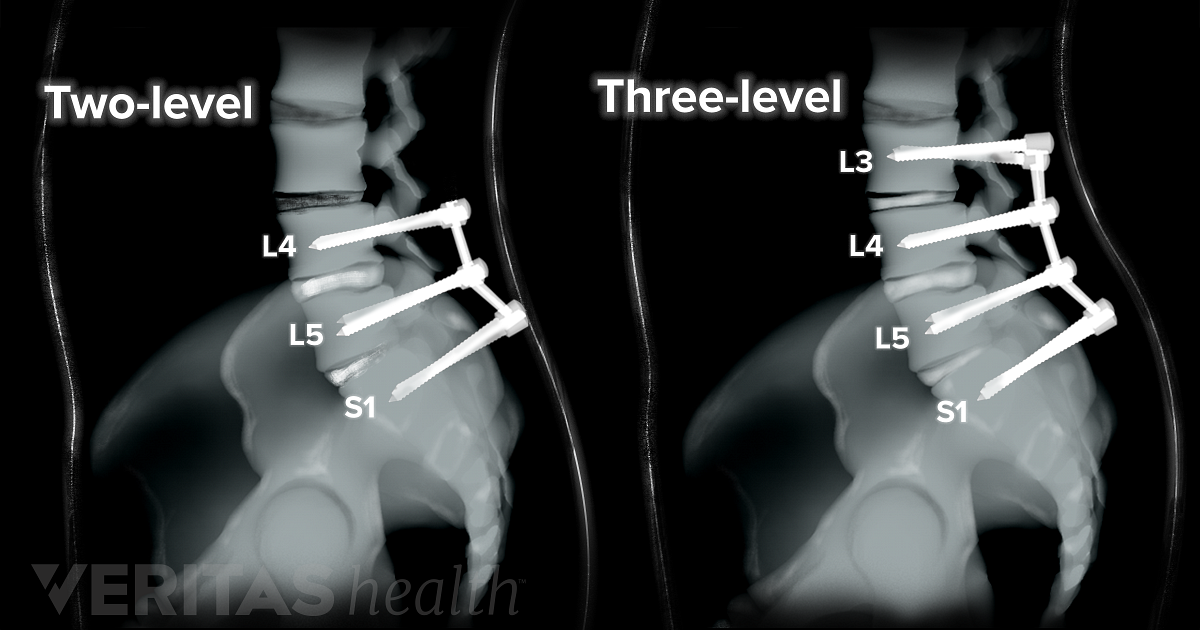 Multilevel Spinal Fusion for Low Back Pain