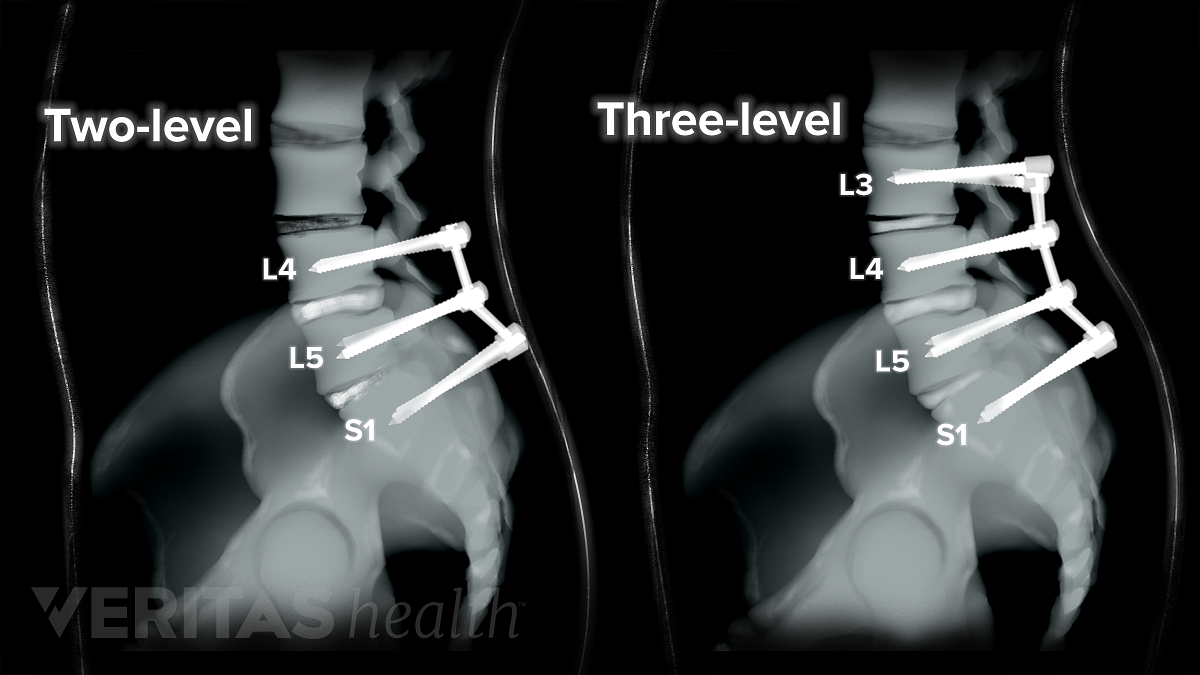 Different Types Of Back Surgery Explained GiancarlokruwJensen