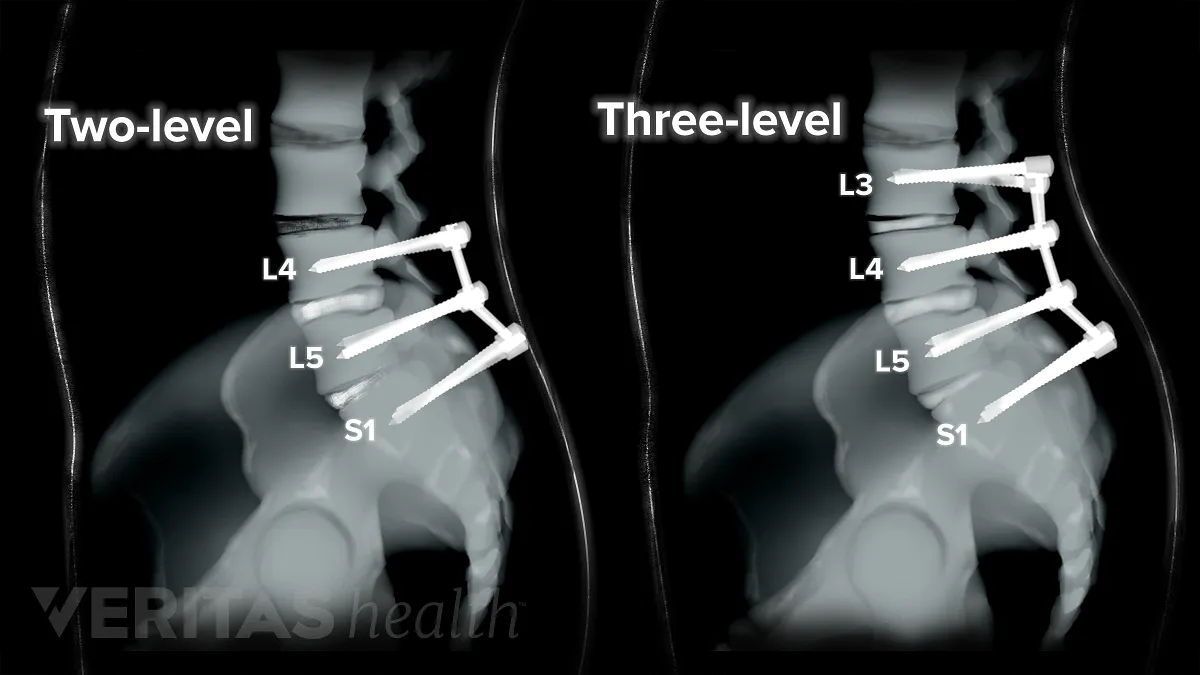 two three level spinal fusion