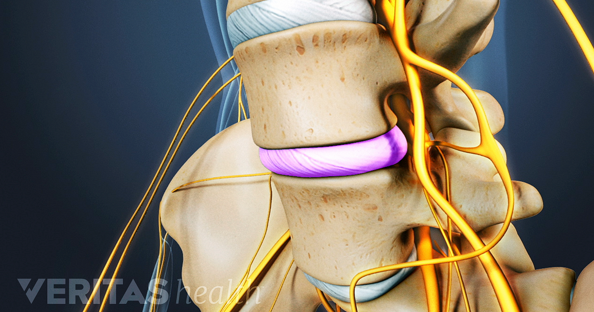 Lumbar Herniated Disc Symptoms