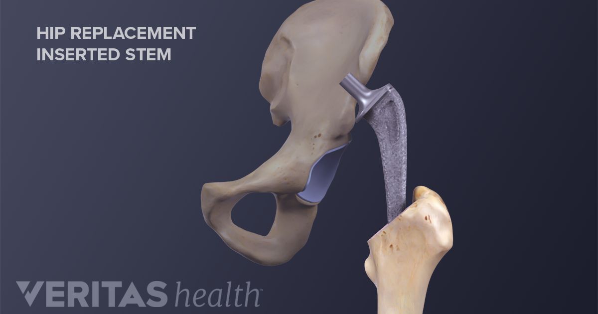 Minimally Invasive Hip Replacement vs. Traditional Hip