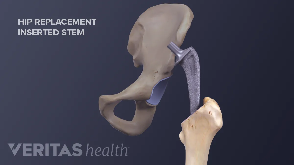 Activities After Total Hip Replacement - OrthoInfo - AAOS