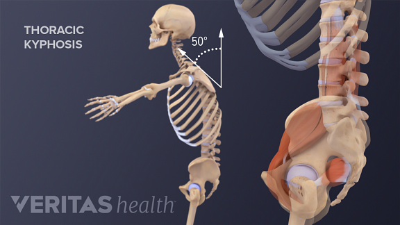Thoracic Kyphosis
