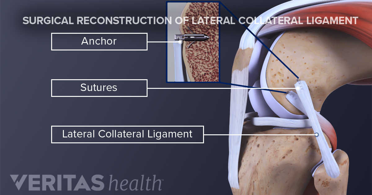 Medial Collateral Ligament Treatment