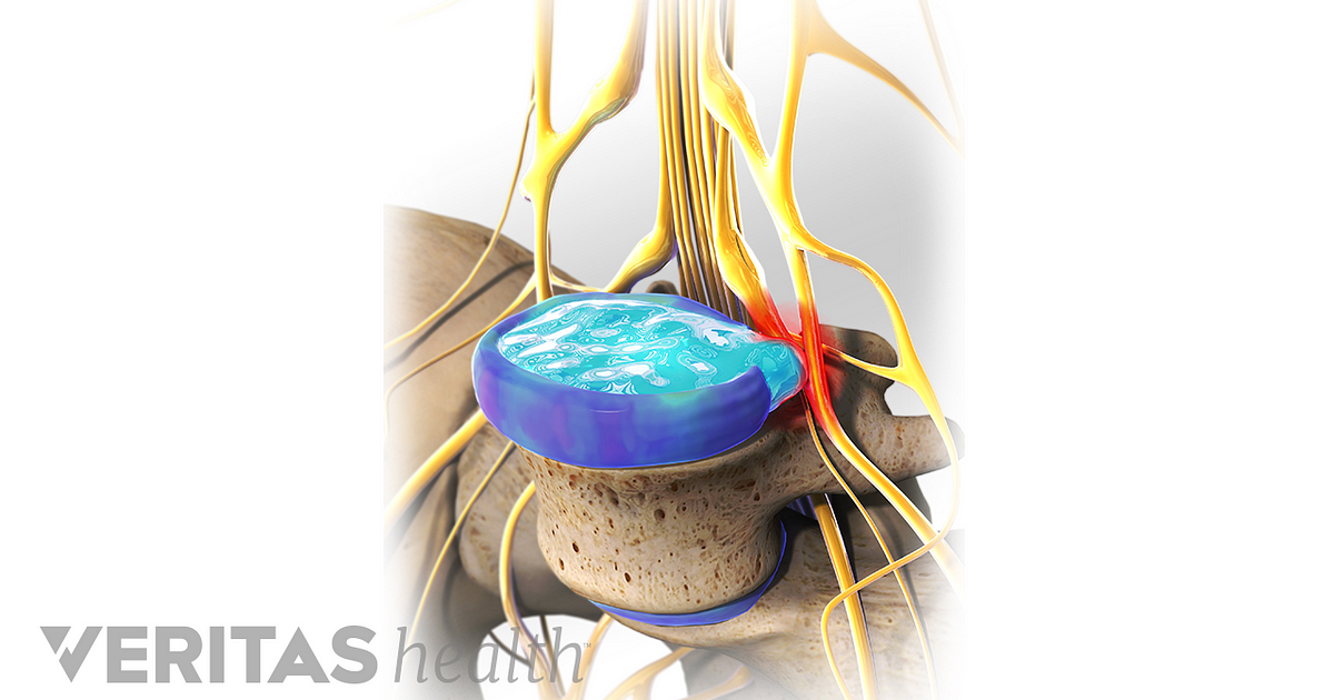 Treatment Options for a Herniated Disc