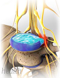 herniated-disc-weak-spots