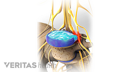 A herniated disc causing compression on the cauda equina nerve.