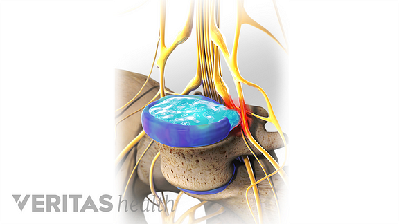 Chiropractors Treat Sciatic Nerve Pain ...