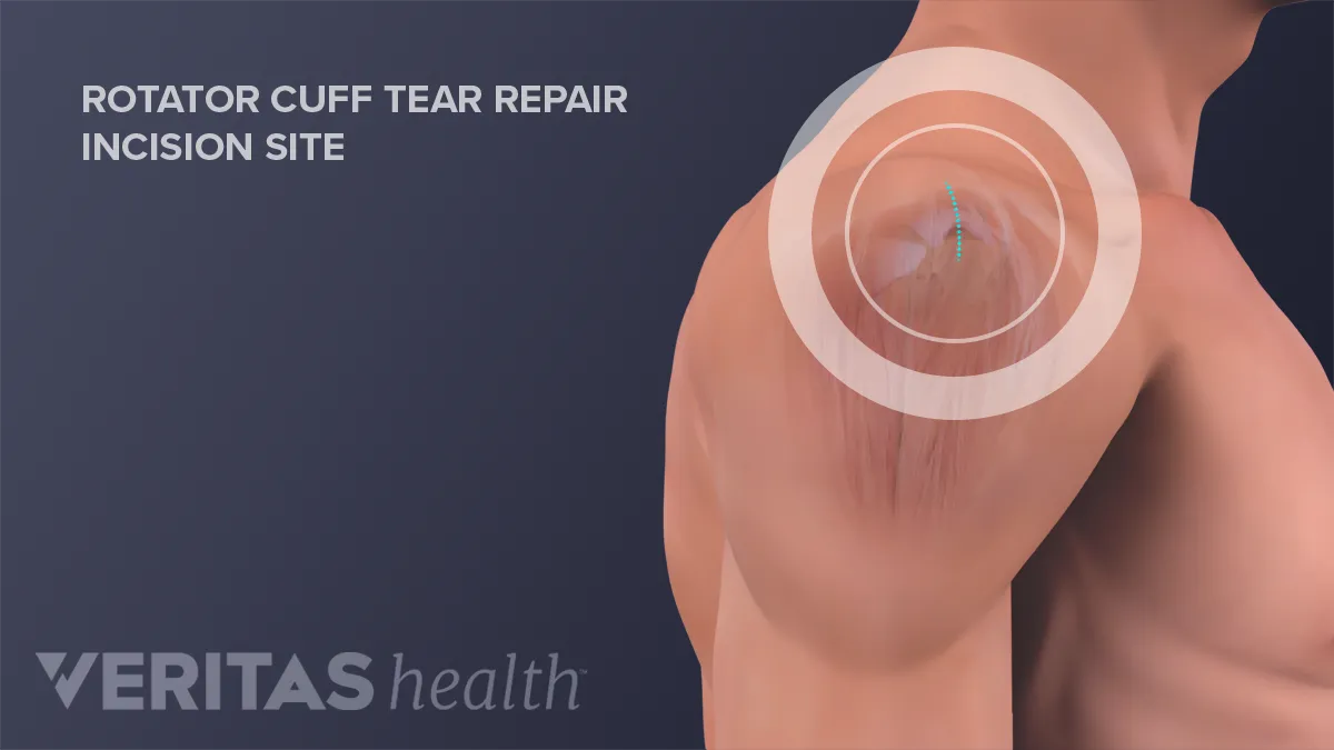 Rotator Cuff Repair: Surgical Technique 