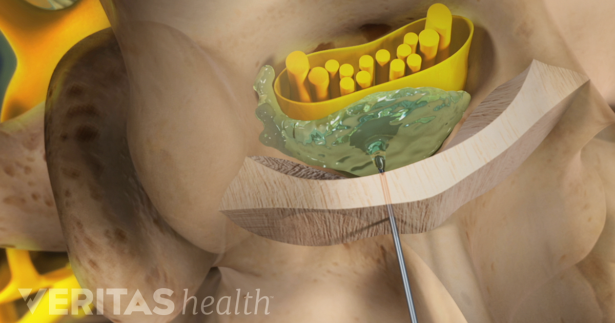 Epidural Steroid Injections 