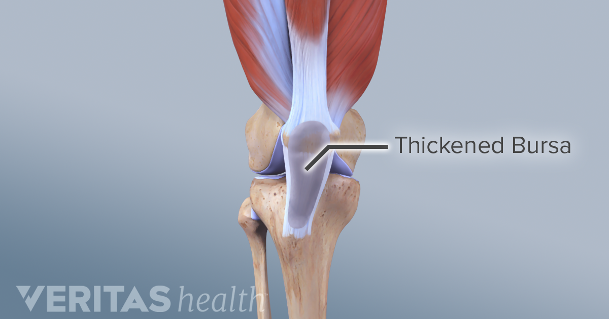 What Is A Bursa Arthritis Health 3157