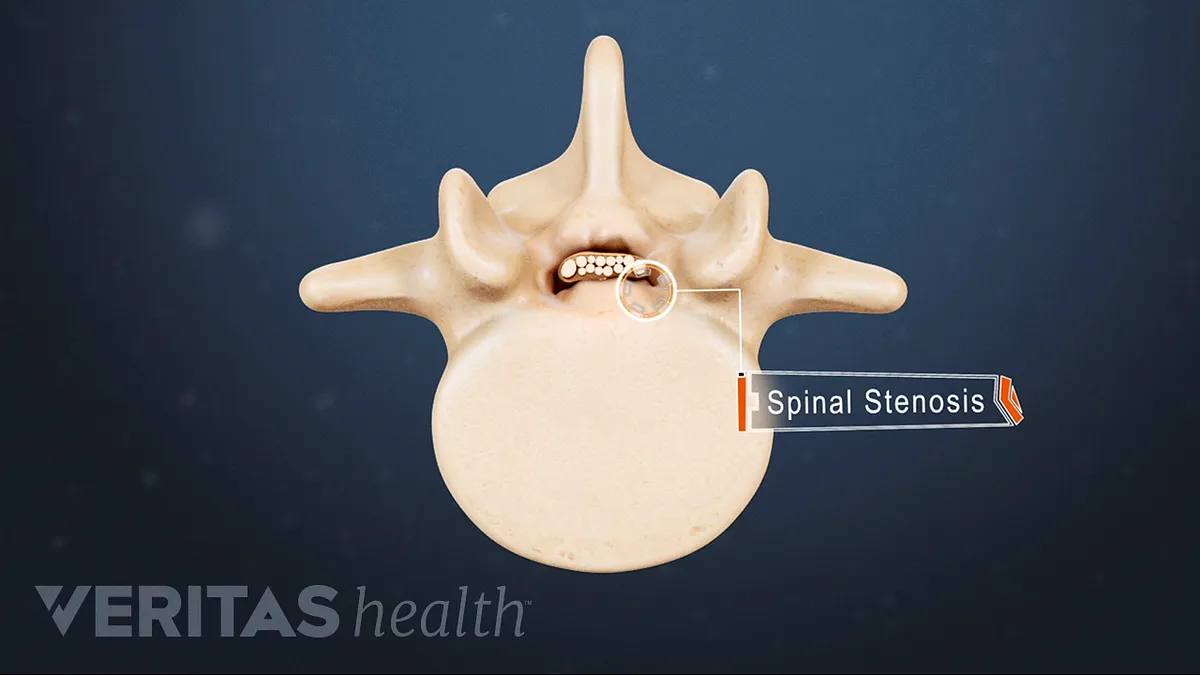 Lumbar Spinal Stenosis Symptoms