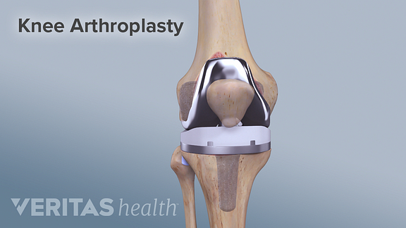 Knee Arthroplasty