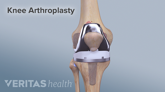 Facts and Considerations for Total Knee Replacement | Arthritis-Health