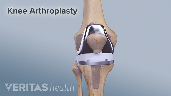 Choosing a Surgeon for Total Knee Replacement | Arthritis-Health